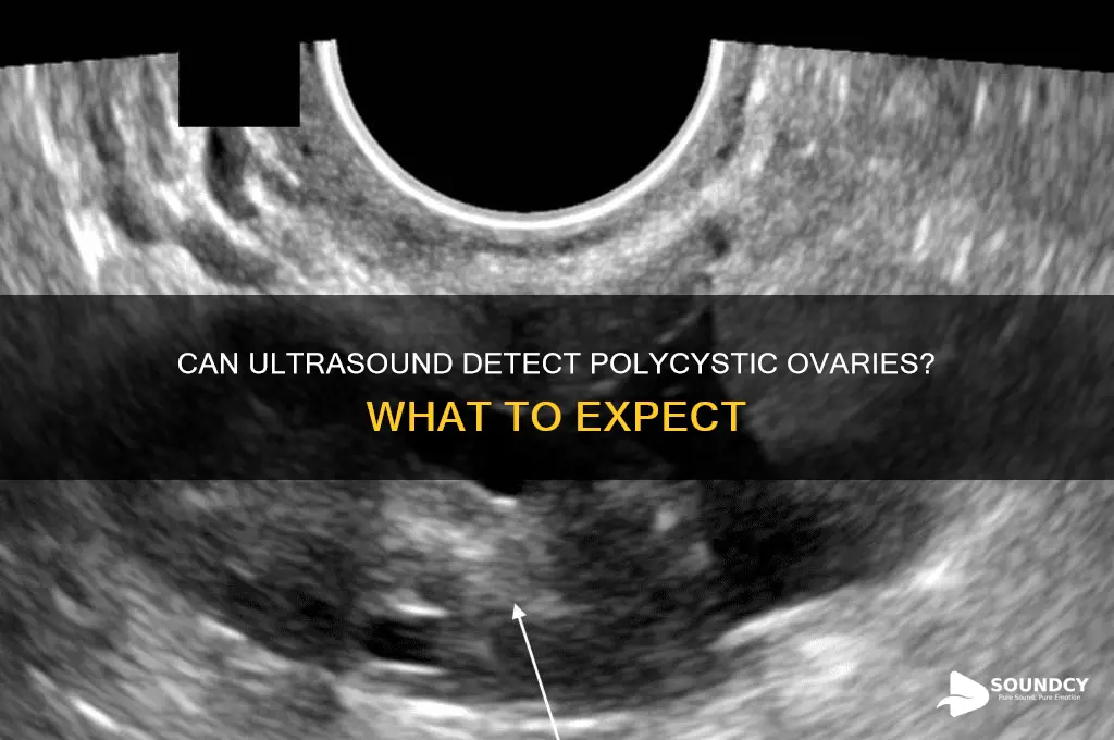 do poly cystic ovaries show up on ultra sound