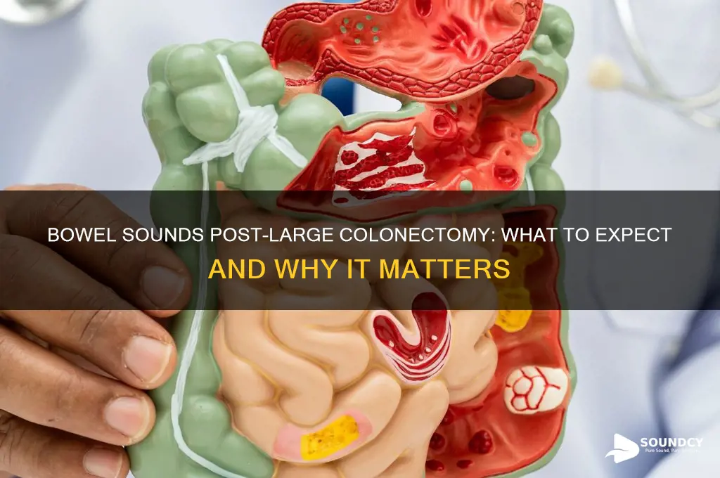 do you have bowel sounds with a large colonectomy