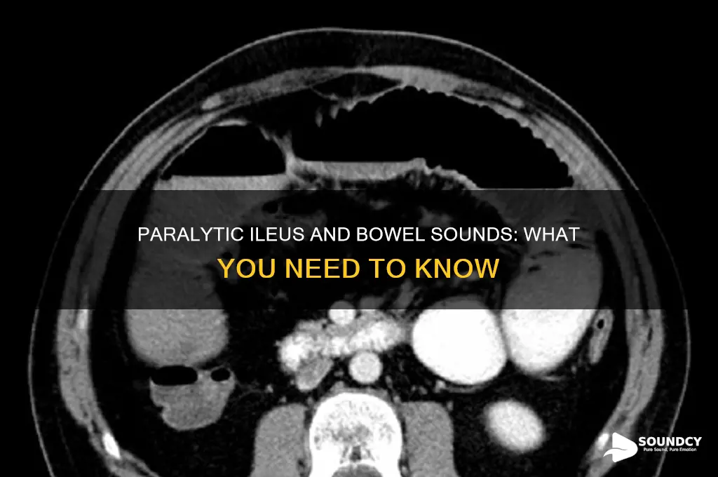 do you have bowel sounds with a paralytic ileum