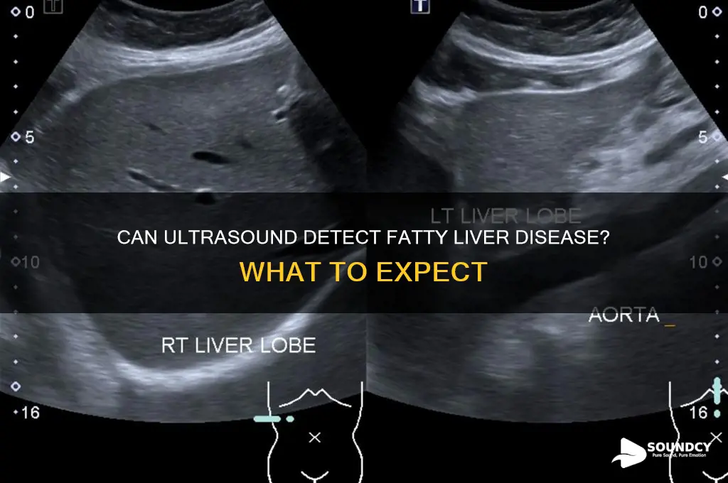 does fatty liver show up in a utra sound