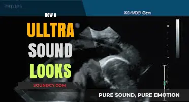 Unveiling the Visuals: What an Ultrasound Image Really Looks Like