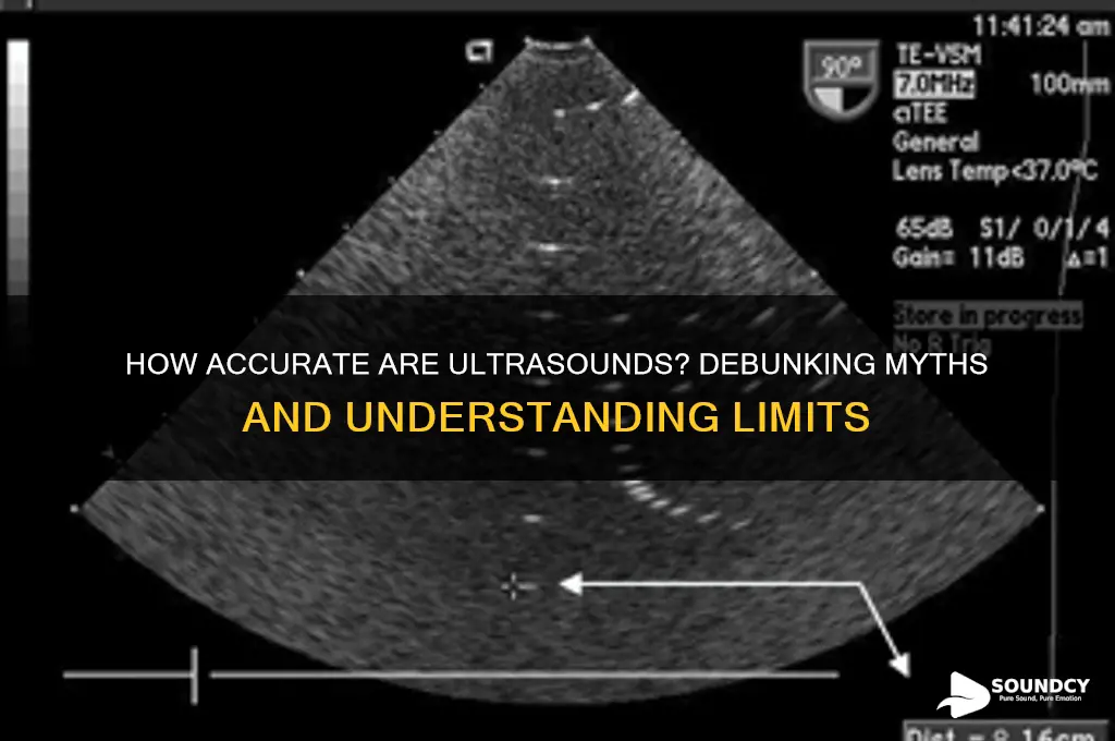 how accurate are ultra sounds