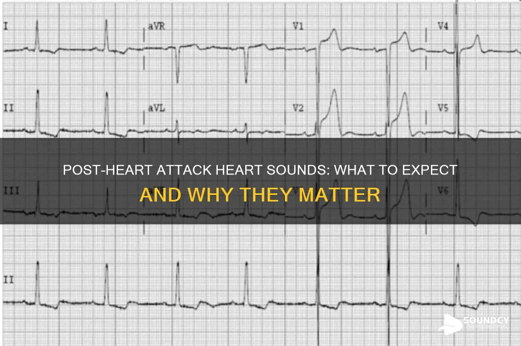 how do the heart sounds after a heart attack