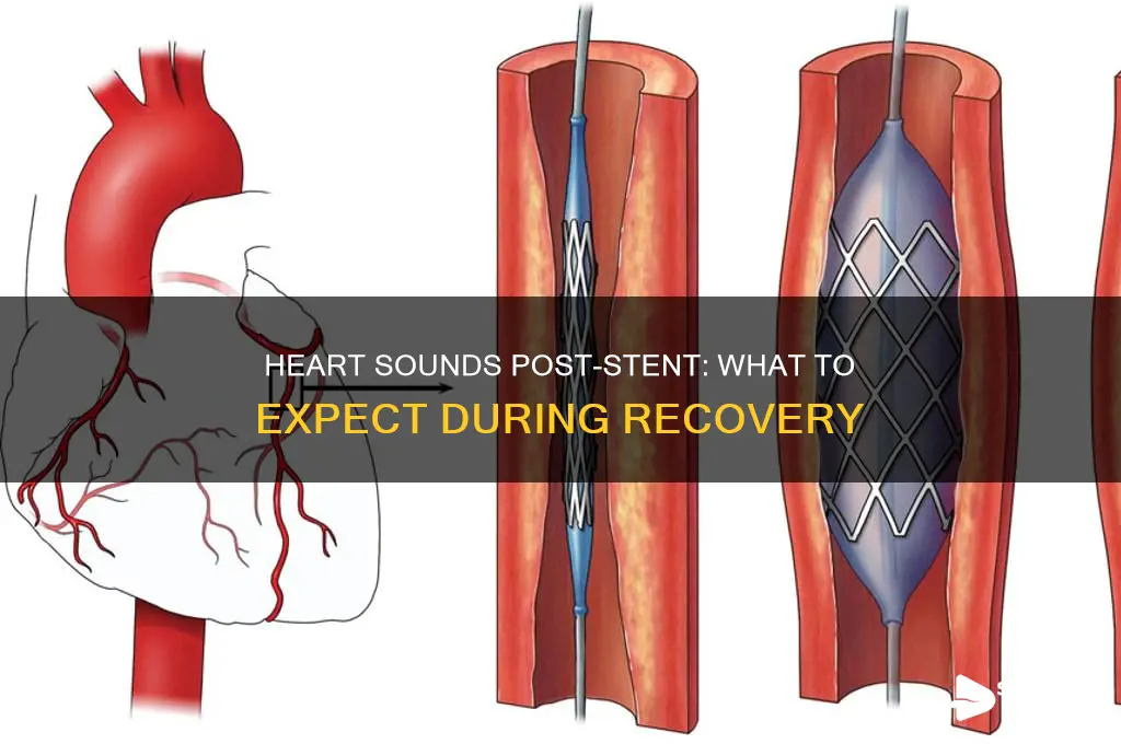 how does heart sound when stent is put in