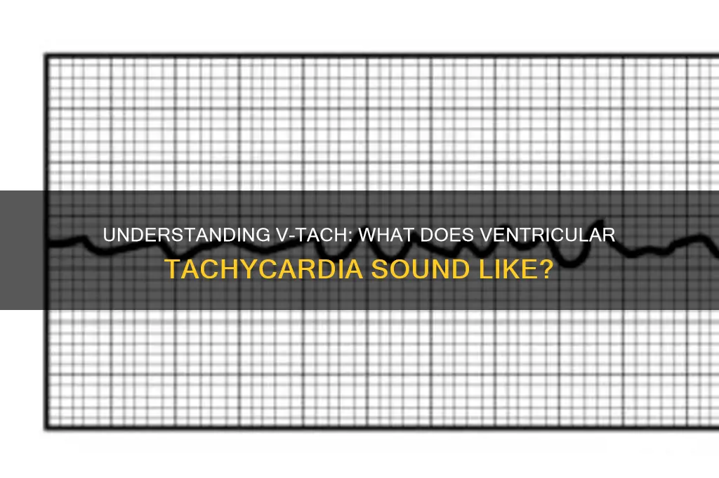 how does v tach sound