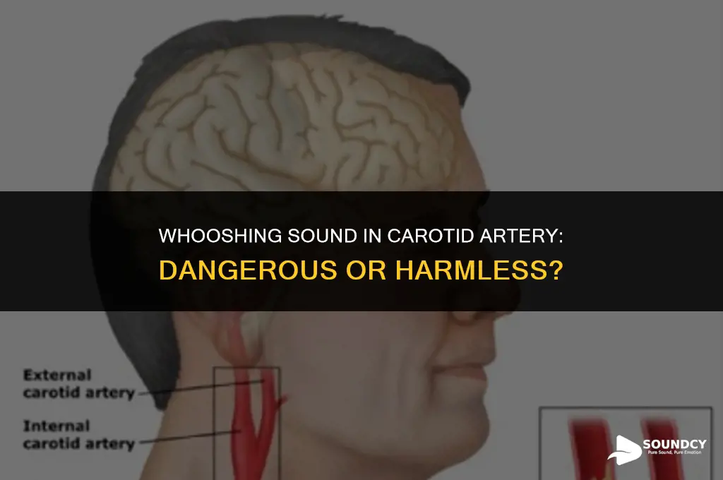 is a whooshing sound in the carotid artery dangerous