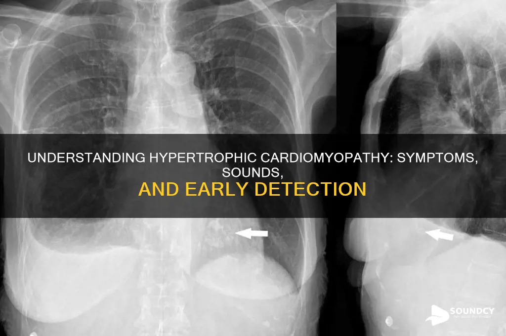 is hypertrophic cardiomyopathy sounds like
