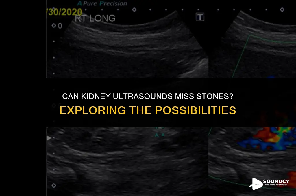 is it possible kidney ultra sound dont show stones