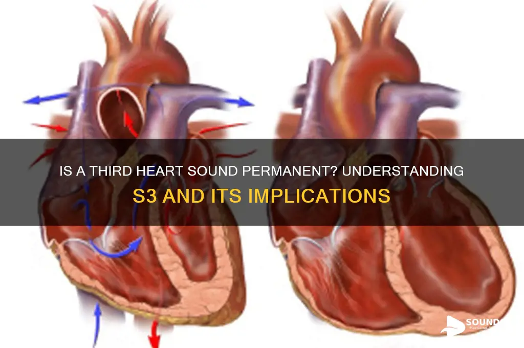 is nthird heart sound permanent