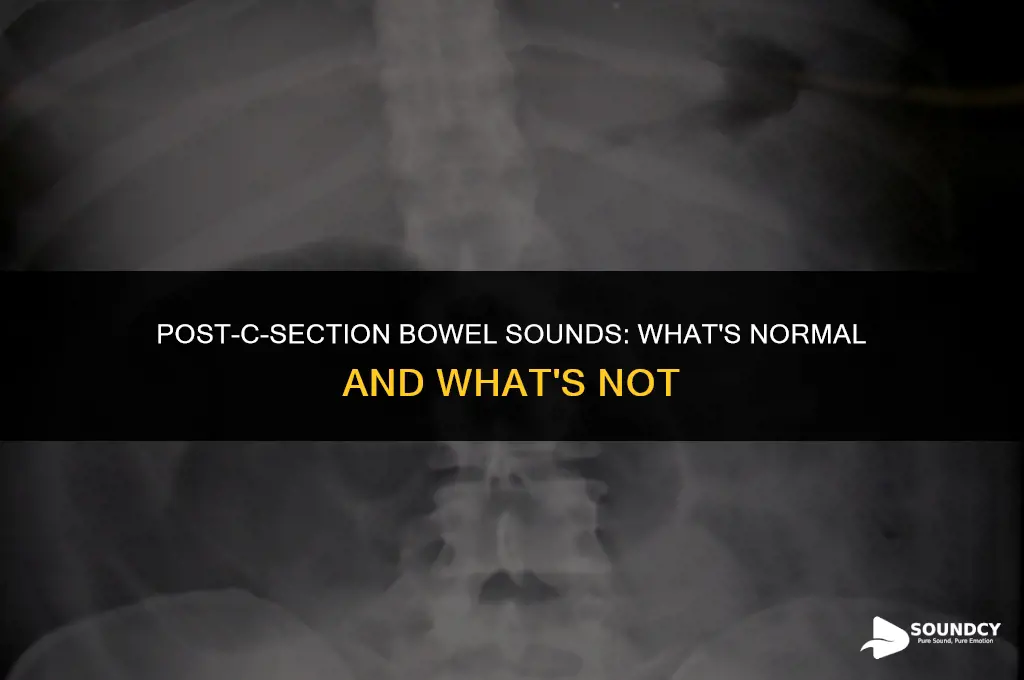 should bowel sounds be present after a c section