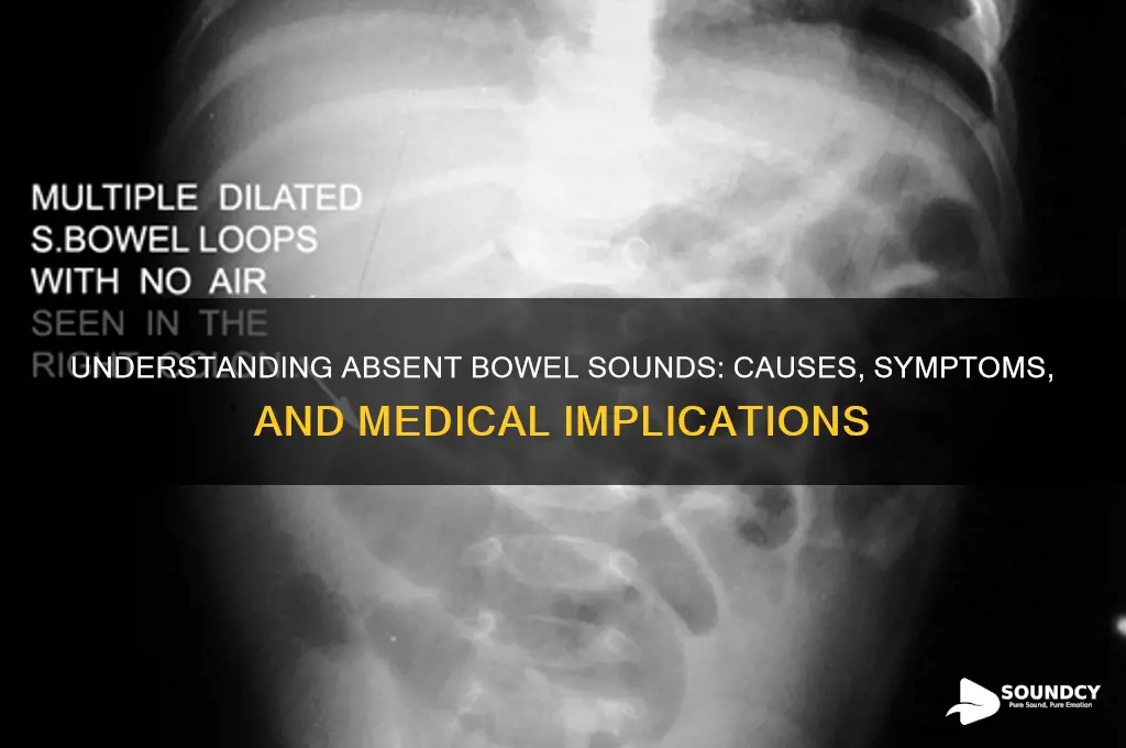 what are absent bowel sounds