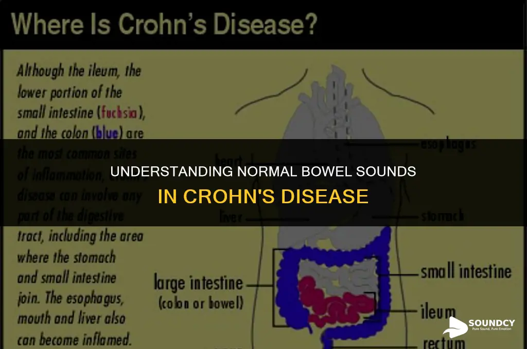 what bowel sounds are normal for crohn