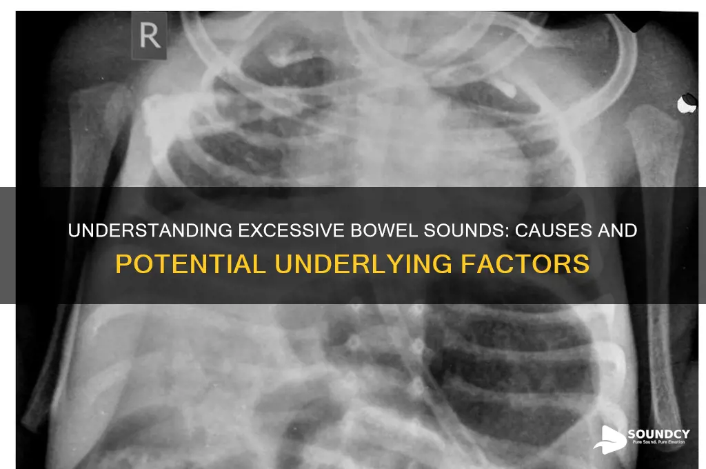 what causes excessive bowel sounds