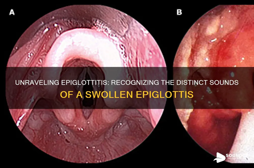 what does epiglottitis sound like
