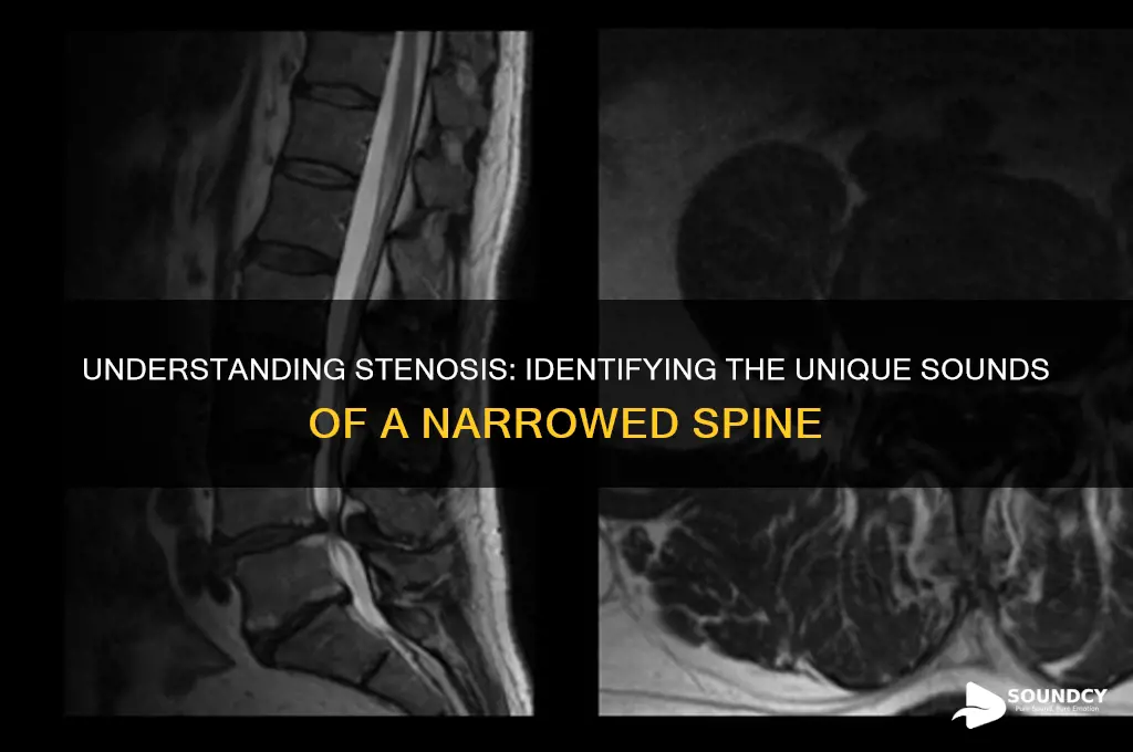 what does stenosis sound like