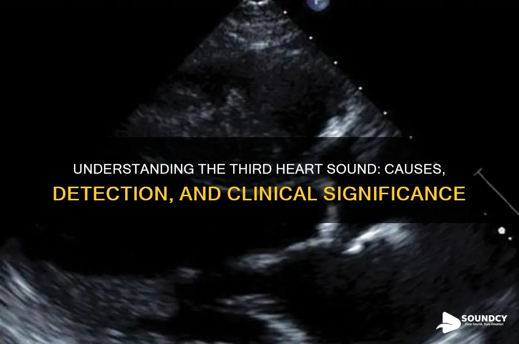what is 3rd heart sound
