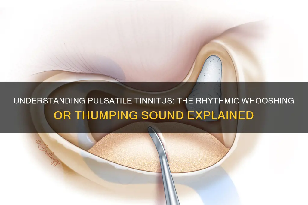 what pulsatile tinnitus sounds like